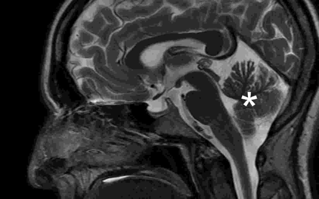 The Cingulate Gyrus: Pain, Attention, And Decisions
