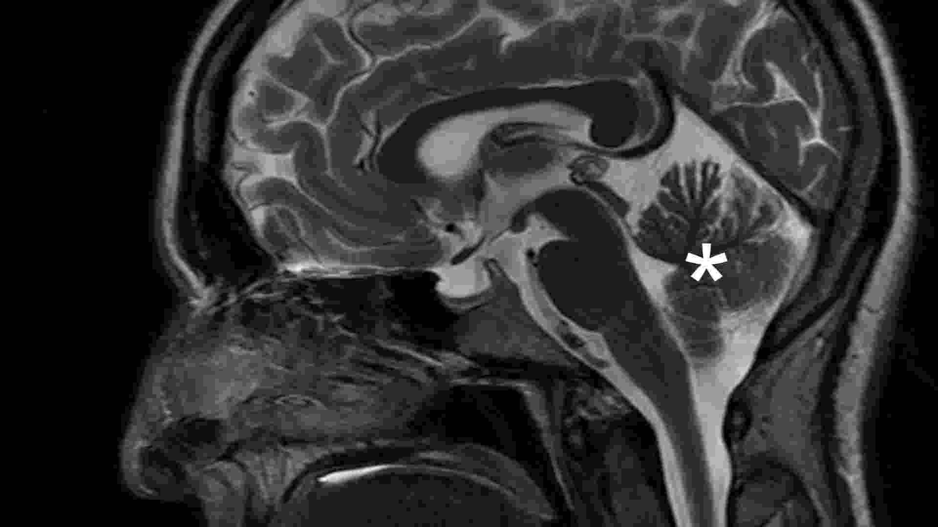 The Cingulate Gyrus